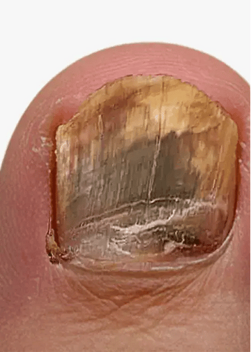 BiosHealth™ Precision AntiFungal Pen For Men