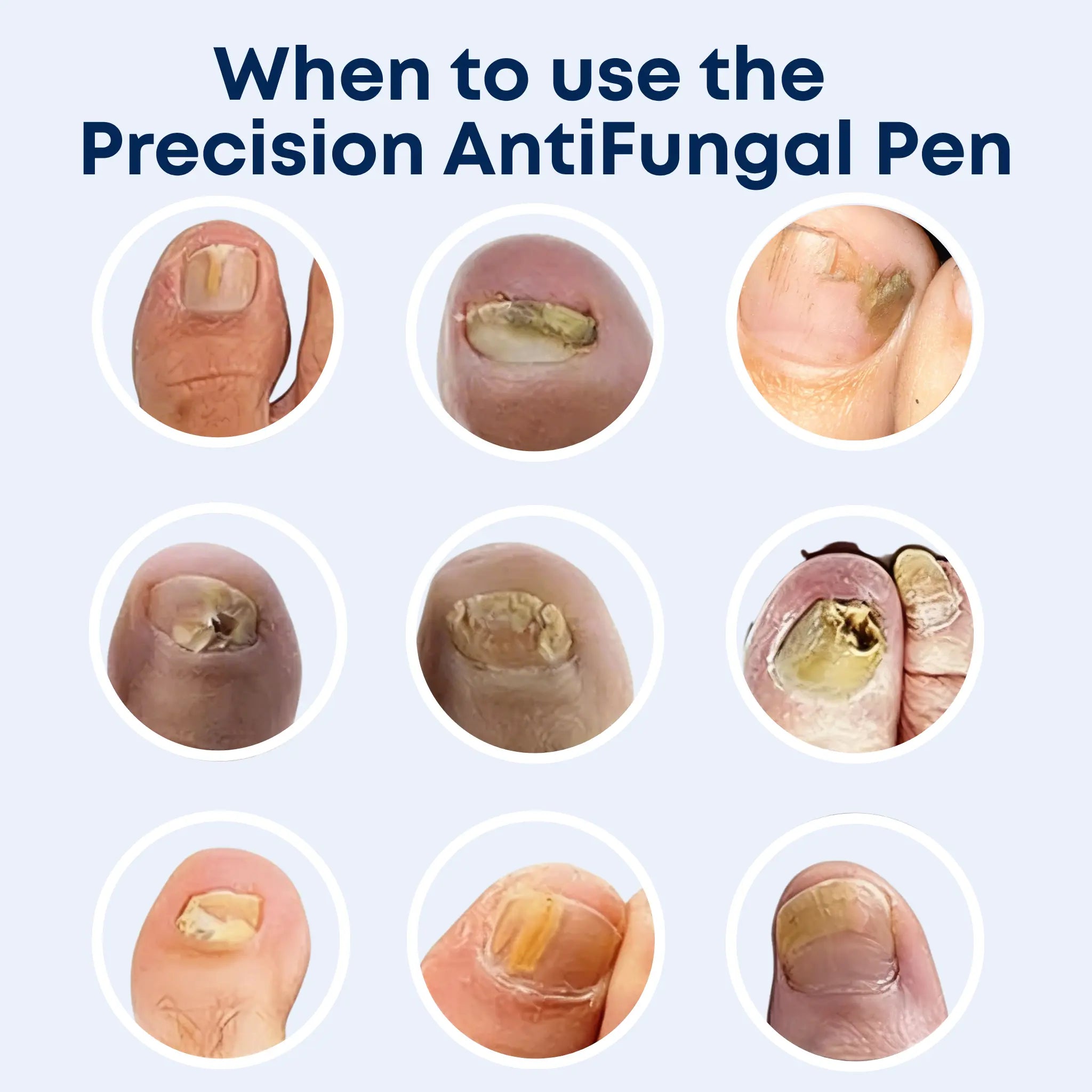 BiosHealth™ Precision AntiFungal Pen For Men