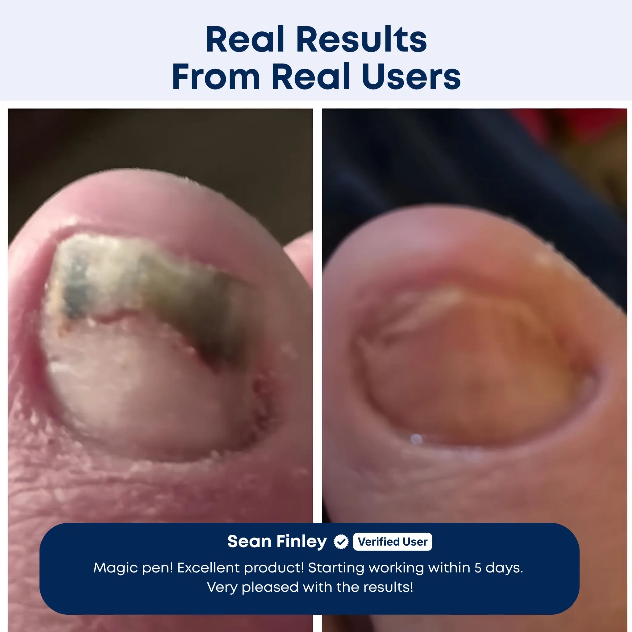 BiosHealth™ Precision AntiFungal Pen For Men