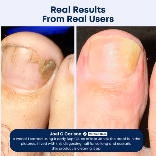 BiosHealth™ Precision AntiFungal Pen For Men